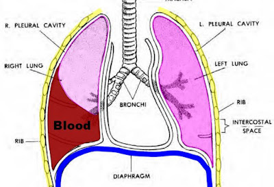 Hemothorax (Definisi Etiologi Klasifikasi dan Pathway)