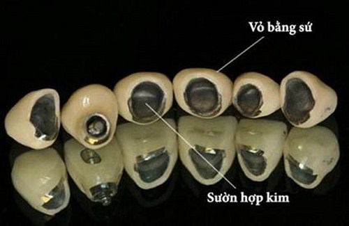 BỌC RĂNG SỨ LOẠI NÀO TỐT NHẤT -2