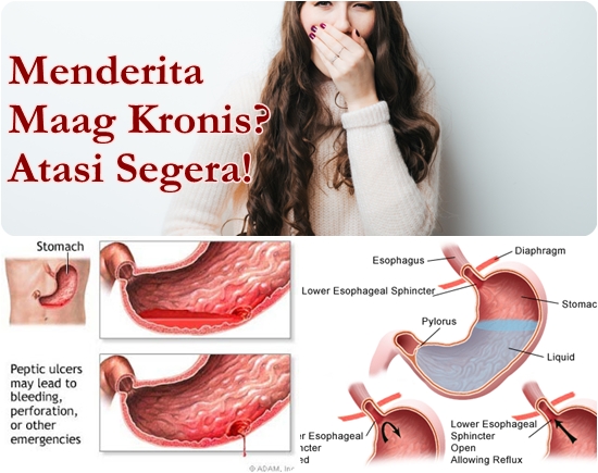 obat maag dan asam lambung kronis paling mujarab obat maag dan asam lambung kronis paling mujarab