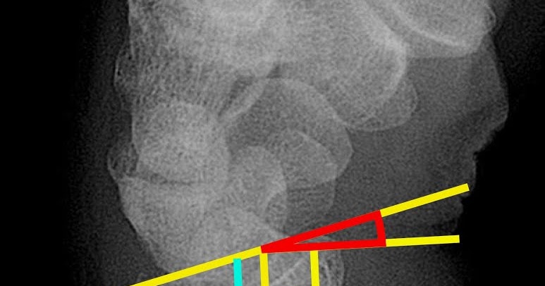Torus Fracture - Treatment | Symptoms | Healing
