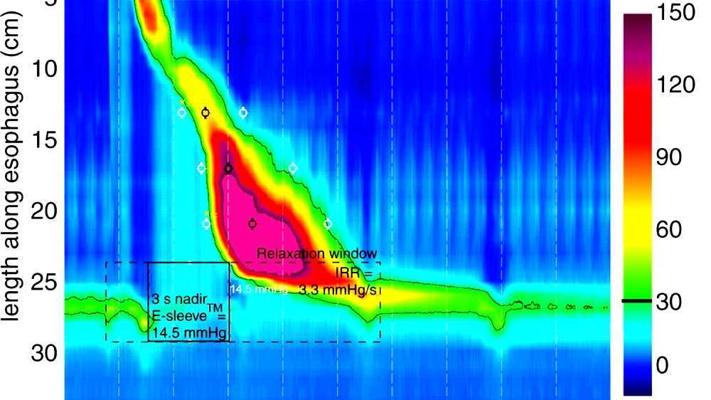Nutcracker esophagus