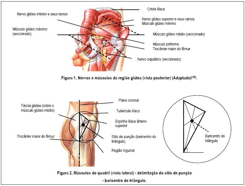 Como Aplicar Injeção No Gluteo Como Aplicar Injeção No Gluteo
