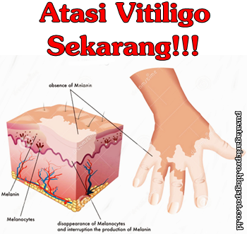 Obat Vitiligo