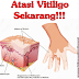 Obat Vitiligo Alami Herbal Terampuh