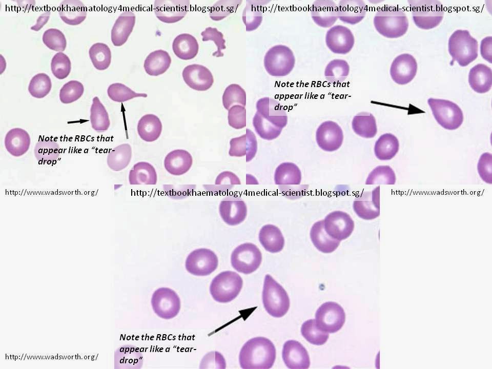 what are tear drop cells what are tear drop cells