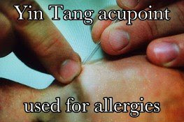 NYC  acupuncture allergy 