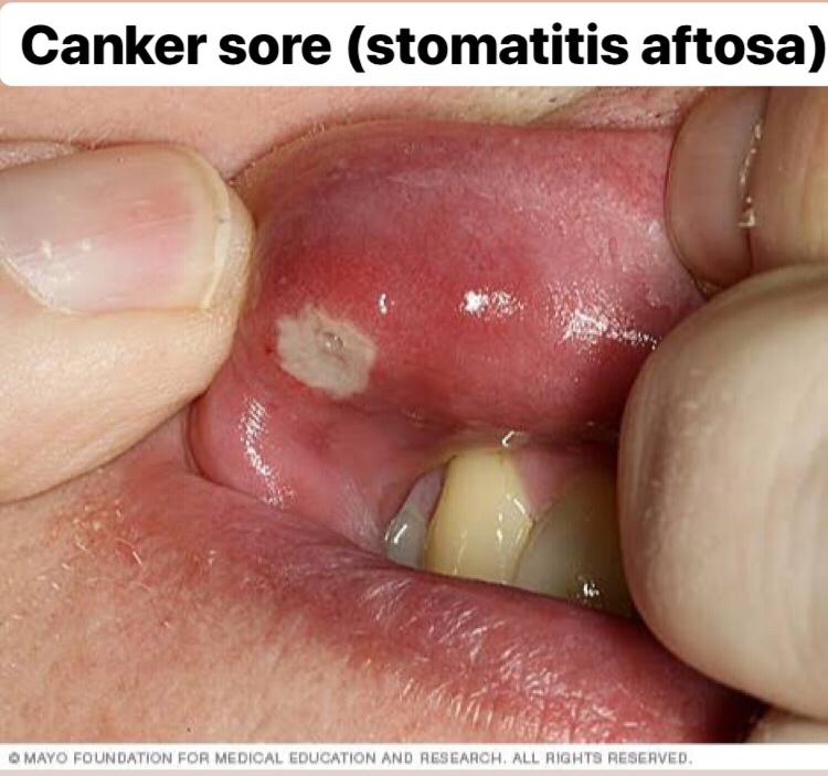 apa itu jamur candidiasis