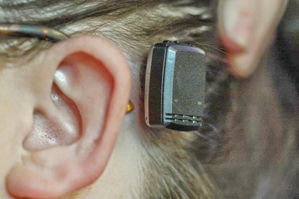 The Baha 4 Attract System Bone Conduction Hearing Device