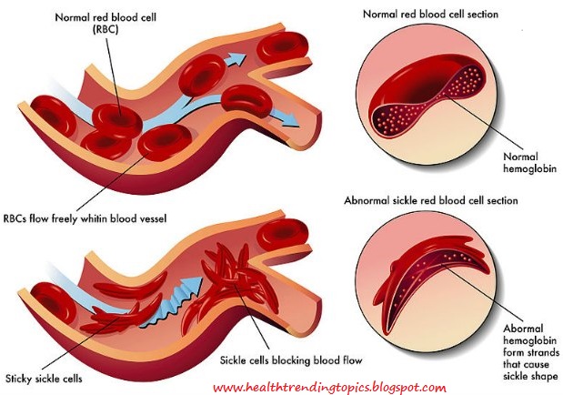 sickle cell anemia disease