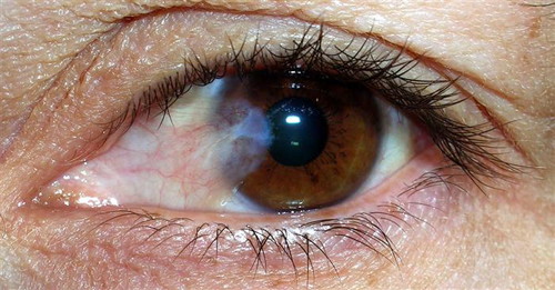keratita oftalmologie
