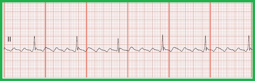 type ii atrial flutter icd 10 type ii atrial flutter icd 10