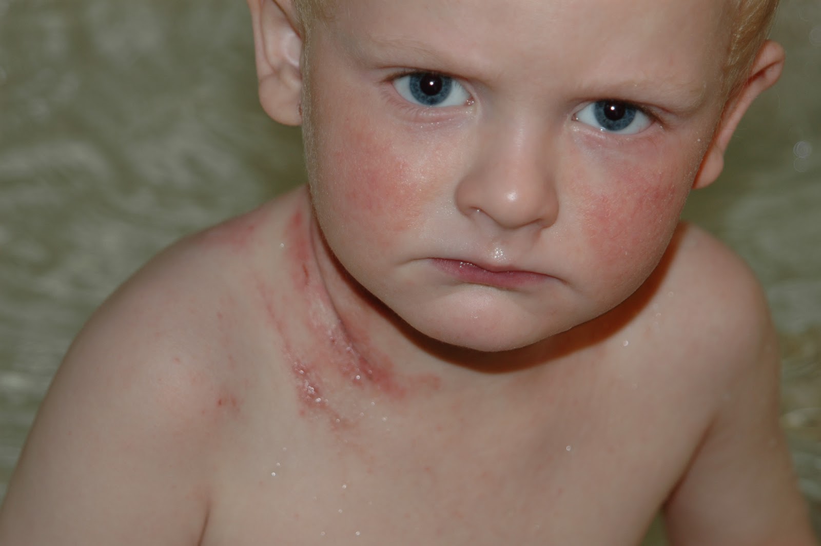 Kline's road from out of control eczema to topical steroid withdrawal