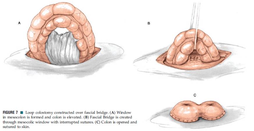 Simple Loop Colostomy Sudiyatmo,MD Blog & Journal: INTESTINAL STOMA