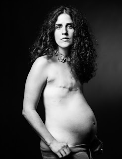 pregnant breast cancer survivor showing scars