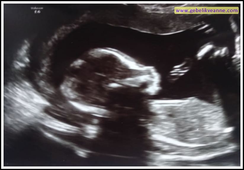 20 Haftalık Gebelik (Hamilelik) Ultrason Görüntüleri