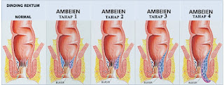 obat ambeien ampuh di apotik