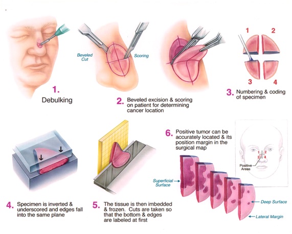 cirugia de carcinoma basocelular en la cara
