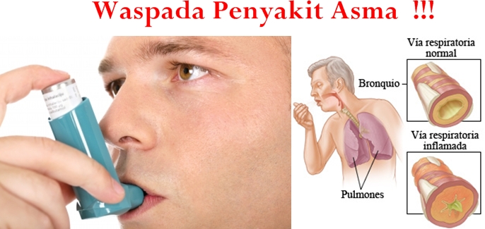 Cetosis para asma