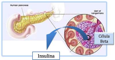 diabetes tipo de células de islotes en el tipo