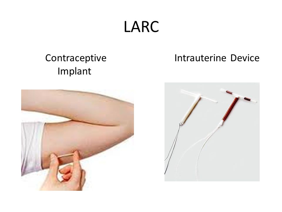 Ob/Gyn Updated ACOG updates its guidelines on LARC
