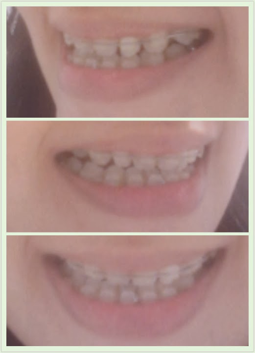 Underbite Braces Journey