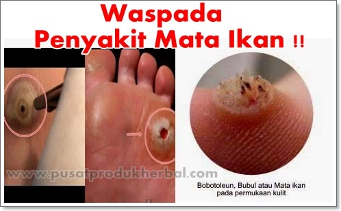 Image result for Obati Mata Ikan Dengan Mudah
