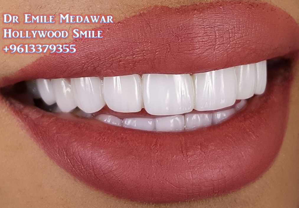 Facette Dentaire, Dr Emile Medawar, 00 961 3 379355 Facettes Dentaires