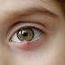 Τι είναι το χαλάζιο στο μάτι και σε τι διαφέρει από το κριθαράκι; Τι χρειάζεται να γίνει για να προληφθεί η υποτροπή; 