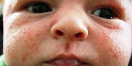 Baby Acne: Causes and Treatments