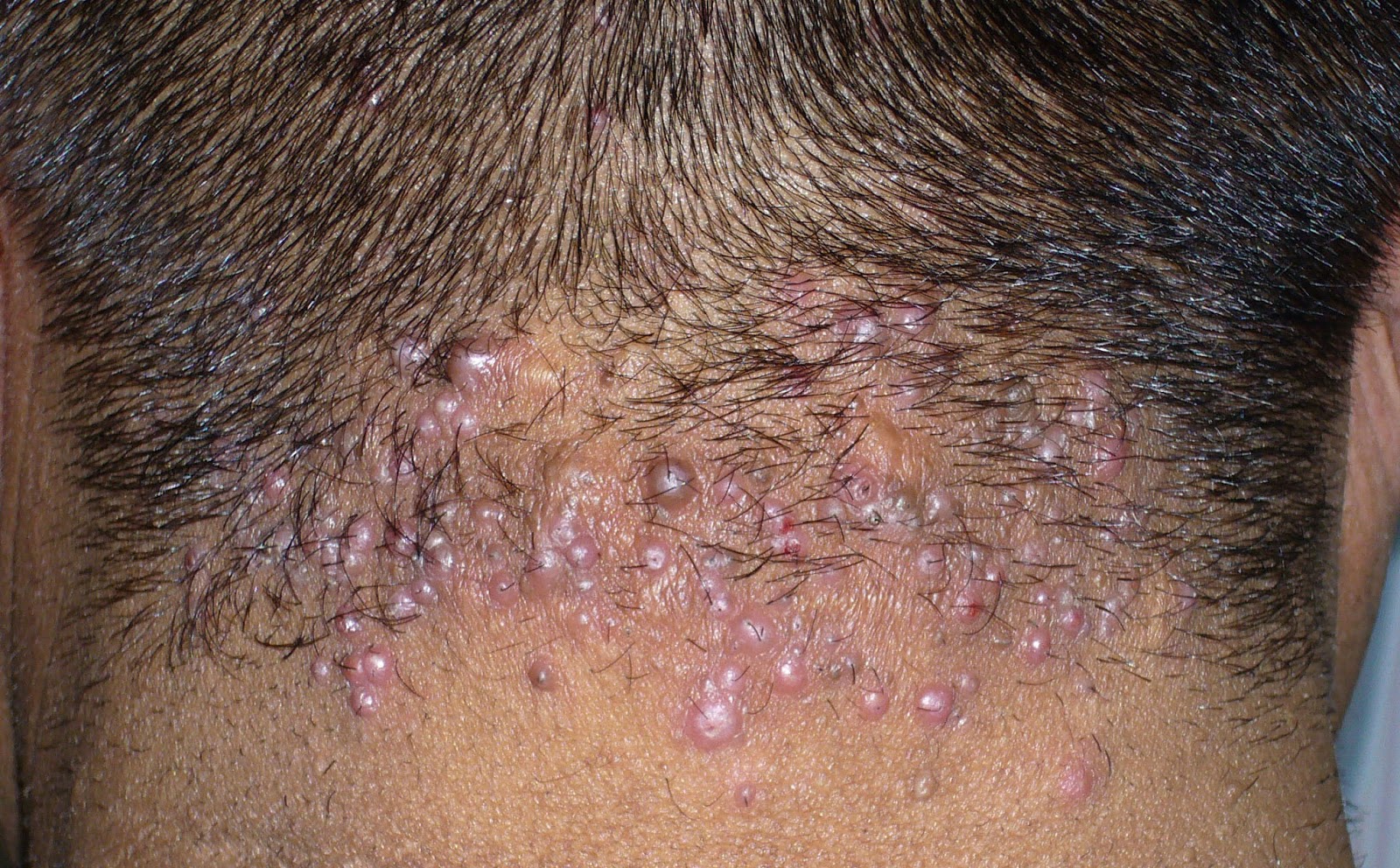 all-about-laser-for-hair-removal