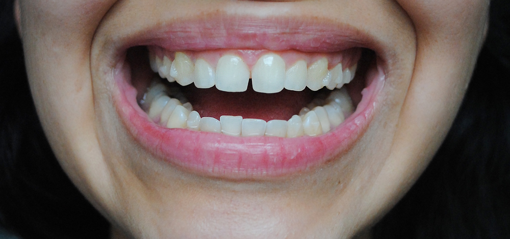 My Life with Invisalign