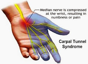 Signs And Symptoms Of Carpal Tunnel Syndrome Signs And Symptoms Of Carpal Tunnel Syndrome