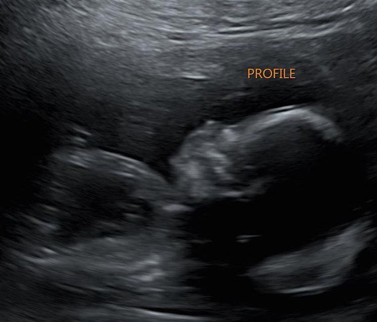 19 Haftalık Gebelik Ultrason Görüntüleri