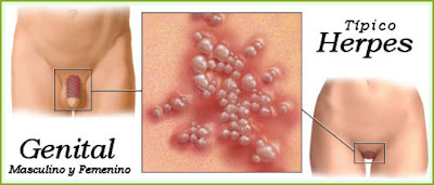 Bagaimanakah cara atasi gatal kulit akibat herpes ? 