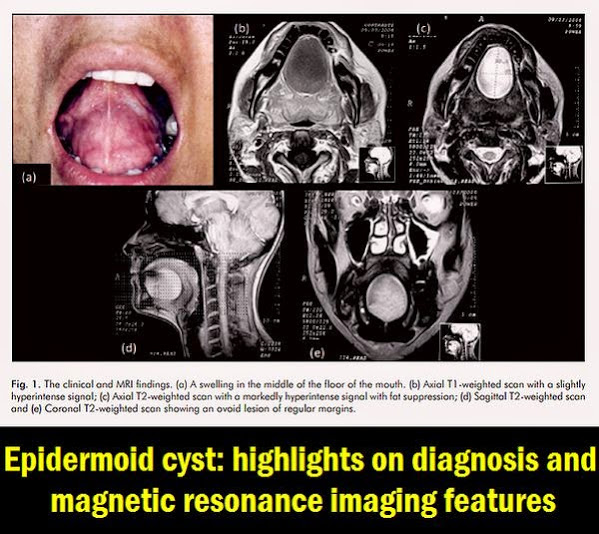 PDF: Epidermoid Cyst: highlights on diagnosis and magnetic resonance imaging features