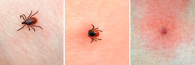 Home Remedies For Chiggers Home Remedies For Chiggers