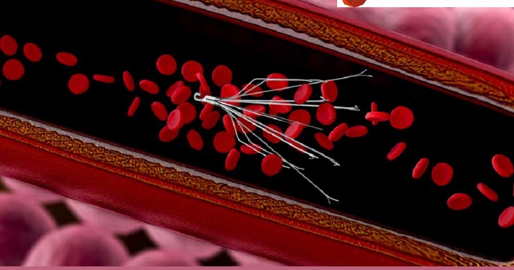 Blood Clot Filter 411