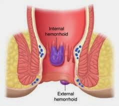 wasir obat herbal wasir
