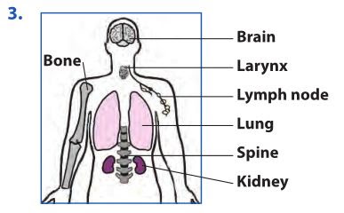 Tuberculosis (TB): Mechanism