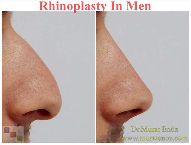 rhinoplasty in men istanbul