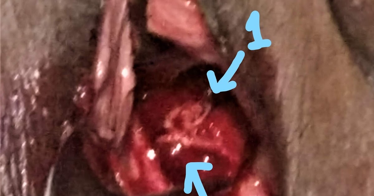 Journal Of Postgraduate Gynecology Obstetrics Vault Granulation Tissue In A Post Hysterectomy Patient