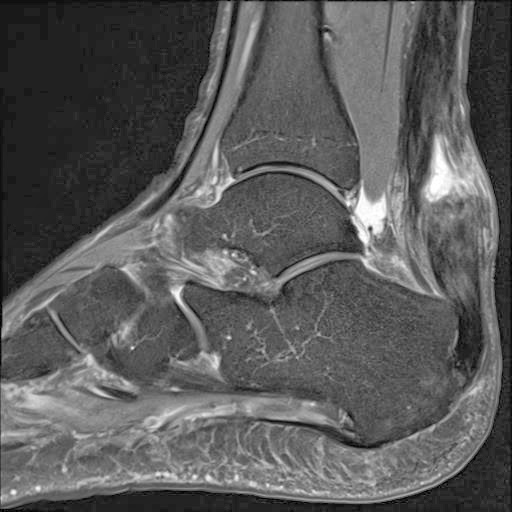 Мрт сухожилия. Мрт сухожилия. Отрыв сухожилия ахиллова сухожилия мрт. Анатомия лучезапястного сустава мрт. Мрт сухожилия.