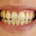 Gigi Anda Kuning dan Bau, Jangan Khawatir Pakai Cara Ini Gigi Anda Putih Bersinar Dalam Dua Menit