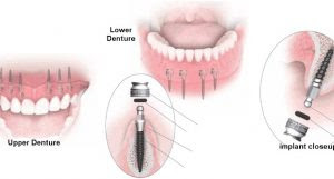 Trồng răng sứ bằng cấy ghép Implant có giá bao nhiêu?
