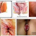 Obat Pria Kena Ambeien Bengkak thumbnail