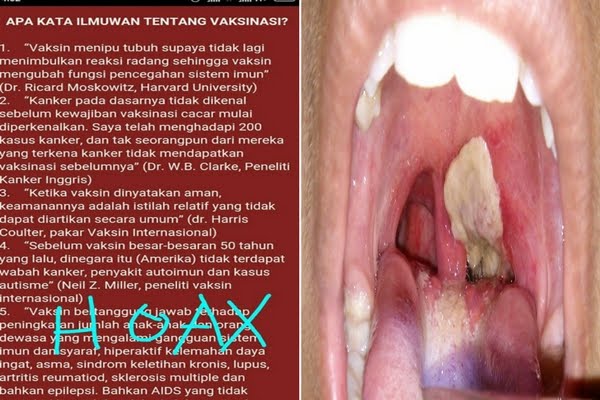 Mengungkap HOAX Konspirasi Imunisasi dan Vaksinasi Setelah Kasus Difteri Mewabah