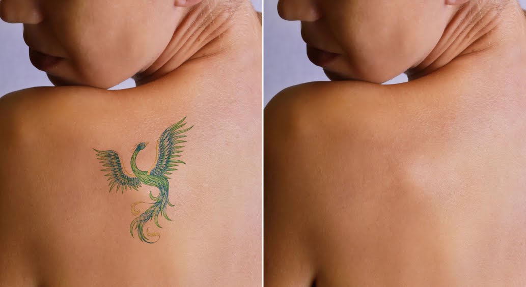 Metodi naturali per rimuovere i tatuaggi.