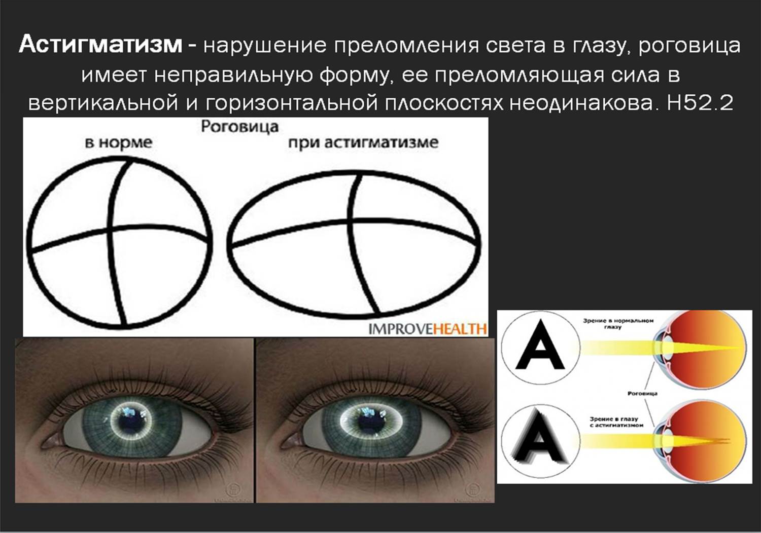 Астигматизм это косоглазие. Близорукость дальнозоркость астигматизм косоглазие. Астигматизм роговицы. Астигматизм это простыми словами. Упражнение для глаз для улучшения для астигматизма.