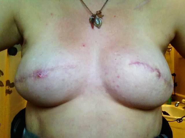nipple reconstruction, breast cancer, survivor, nipple, reconstruction, surgery, procedure