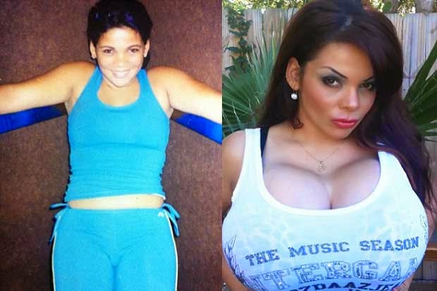 After having emergency surgery to remove her breast implants due to an infe...